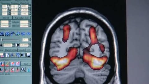 Auf einer Kernspintomographie-Aufnahme ist ein Gehirn im Querschnitt zu sehen (Foto: WDR)