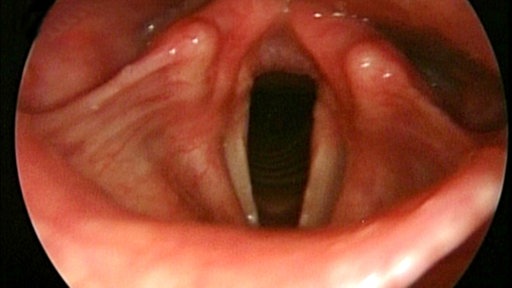 Bild der Stimmlippen eines Sängers