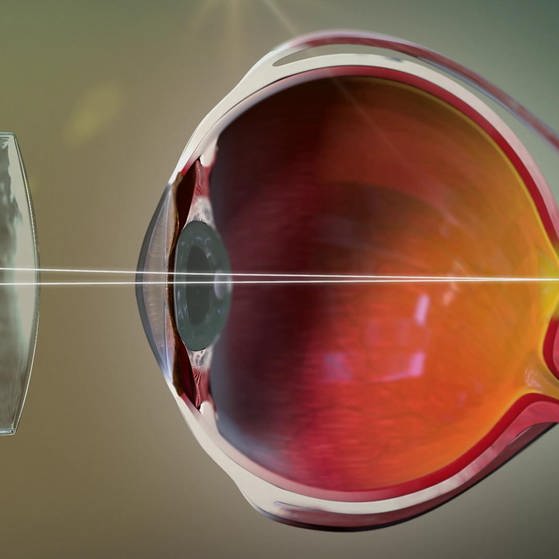 Animation: Querschnitt eines weitsichtigen Auges mit vorgesetzter Linse. (Foto: SWR – Screenshot aus der Sendung)