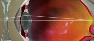 Animation von Kurzsichtigkeit