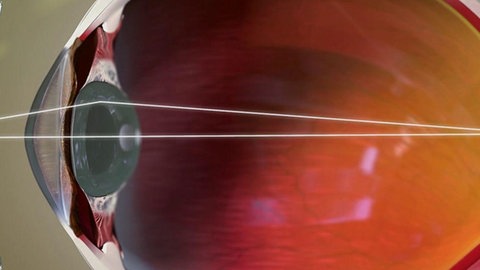 Animation von Kurzsichtigkeit