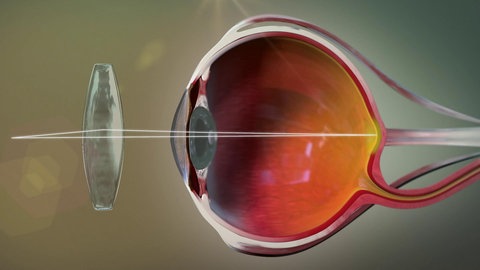 Animation: Querschnitt eines weitsichtigen Auges mit vorgesetzter Linse.