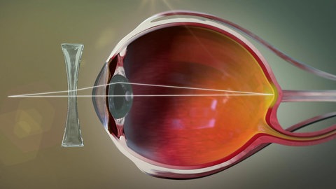 Animation: kurzsichtiges Auge mit vorgesetzter Linse.