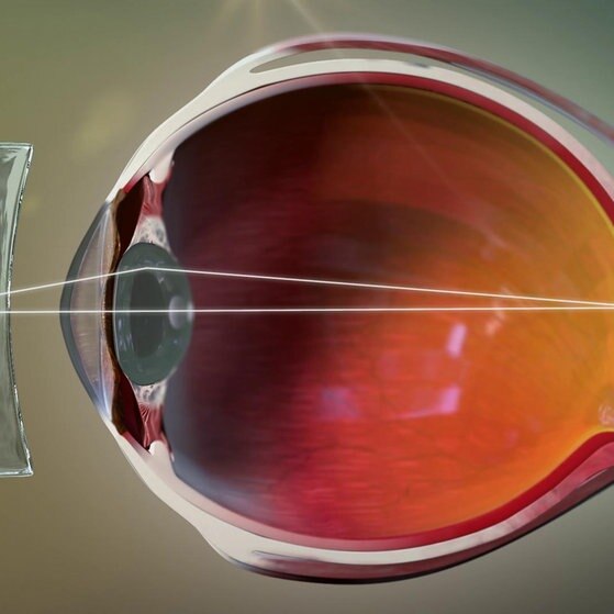 Animation: kurzsichtiges Auge mit vorgesetzter Linse.