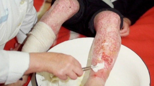 Radioaktiv verbranntes Bein.