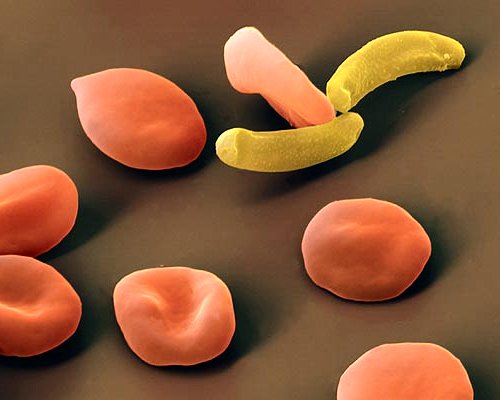 Sichelzellen