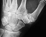 Arthrose des Daumengelenks