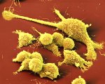 Krebszellen ©eye of science