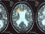 Brain damage through multiple sclerosis