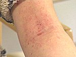 Neurodermatitis