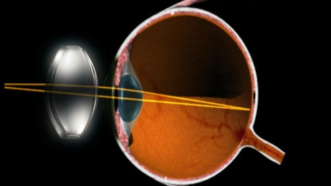 Warum brauchen manche Menschen eine Brille? · Frage trifft Antwort