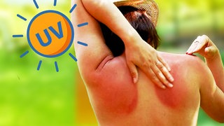 Frau von hinten, fasst sich an den Sonnenbrand am Rücken. Warum müssen wir unsere Haut schützen?