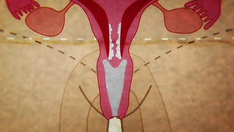 Animiert – Die Gebärmutter und der Scheideneingang sind zu sehen, in ihm befindet sich ein weißer Ausfluss