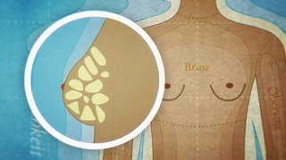 Animiert – Ein Körper ist, daneben eine Brust in der das Drüsengewebe eingezeichnet ist. 