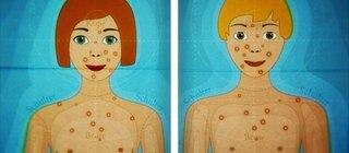 Animiert -  Ein Junge und ein Mädchen mit Pickeln im Gesicht und am Oberkörper. 