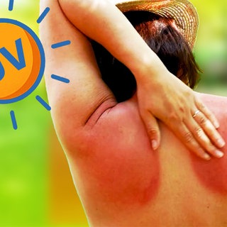 Frau von hinten, fasst sich an den Sonnenbrand am Rücken. Warum müssen wir unsere Haut schützen?